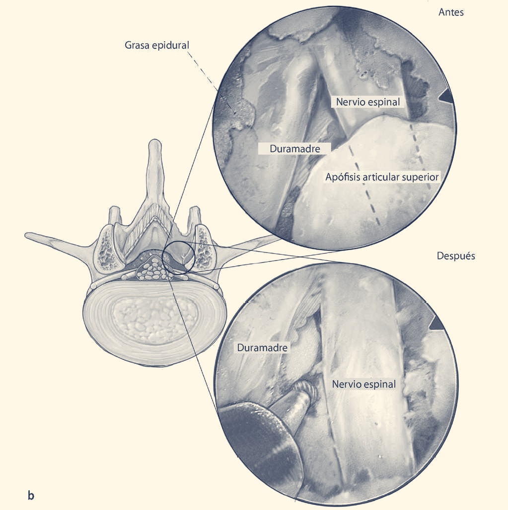 Ilustración anatómica de descompresión endoscópica UBE - vista axial vértebra lumbar y campo quirúrgico antes y después - Dr. Vilatela Valencia