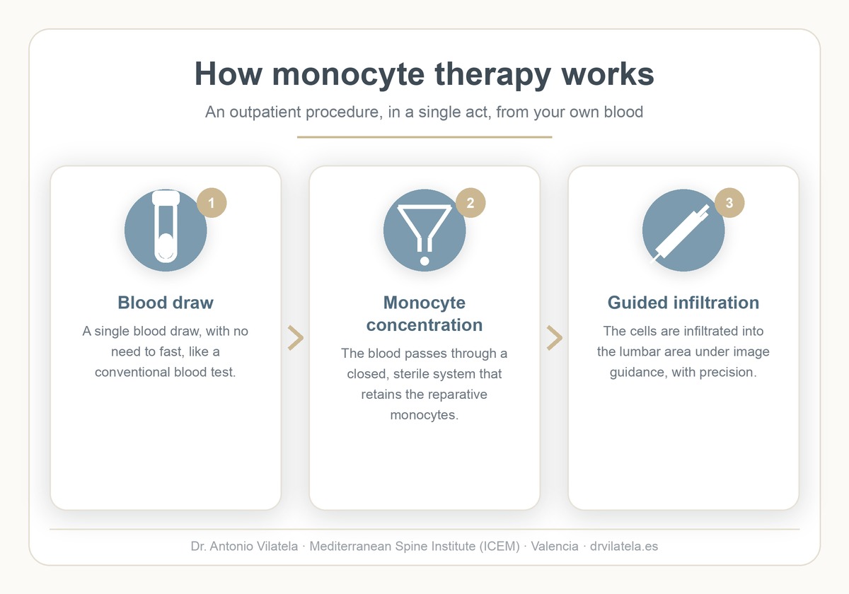 Infographic: how monocyte therapy works for the lumbar spine (blood draw, monocyte concentration and guided infiltration). Dr. Vilatela, Valencia.