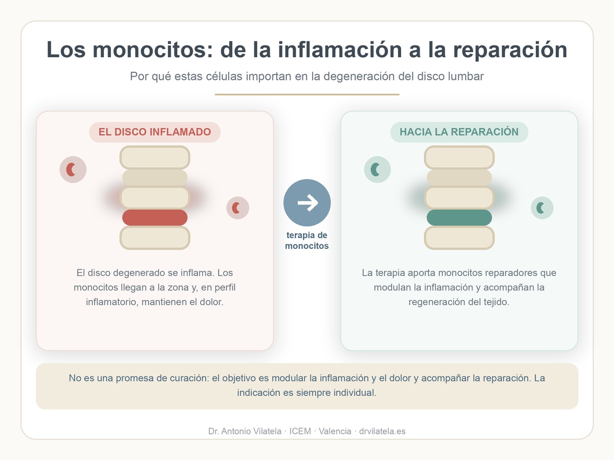 Infografía: papel de los monocitos en el disco lumbar, de la inflamación a la reparación. Dr. Vilatela, Valencia.