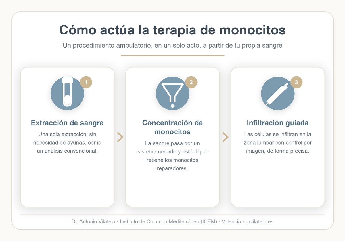 Infografía: cómo actúa la terapia de monocitos en la columna lumbar (extracción de sangre, concentración de monocitos e infiltración guiada). Dr. Vilatela, Valencia.